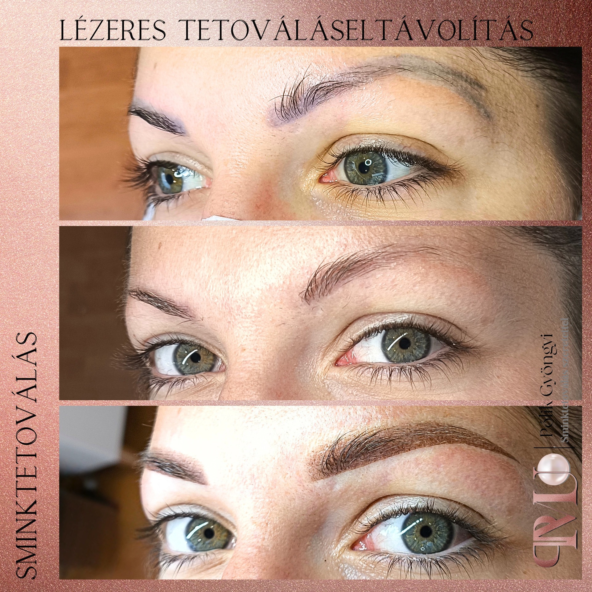 Dupla végű szemöldöktetoválás eltávolítása lézerrel, majd az egészséges bőr újratetoválása