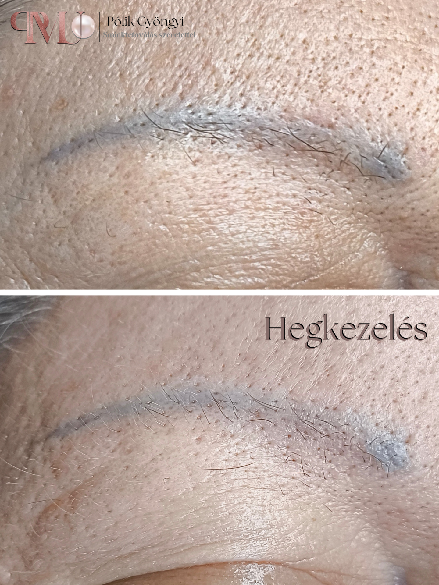 Folyamatban lévő hegkezelés 3 alkalom után 