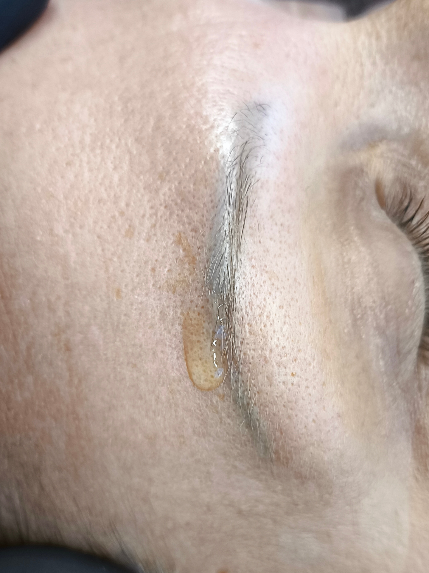 Egy csepp Scar Relaxing Serum a szemöldök heges területén hegkezelés közben